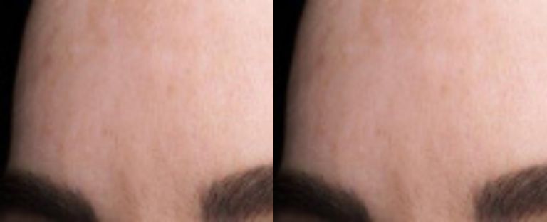 pixel skin resurfacing BA dallas