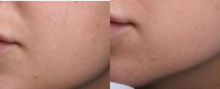 pixel skin resurfacing BA dallas