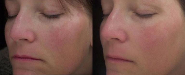 pixel skin resurfacing BA dallas