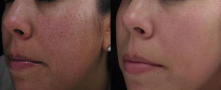 pixel skin resurfacing BA dallas