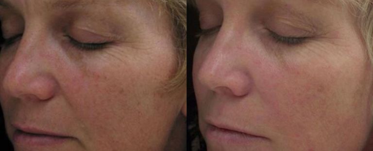 PhotoFacial BA Dallas