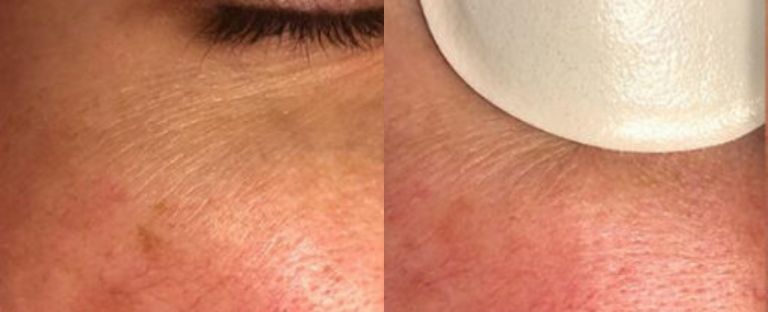 PhotoFacial BA Dallas