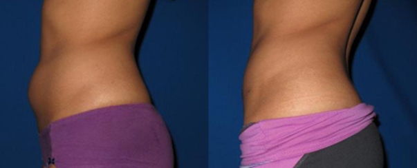 CoolSculpting BA Dallas