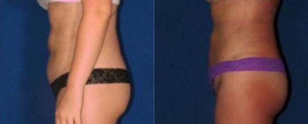 CoolSculpting BA Dallas