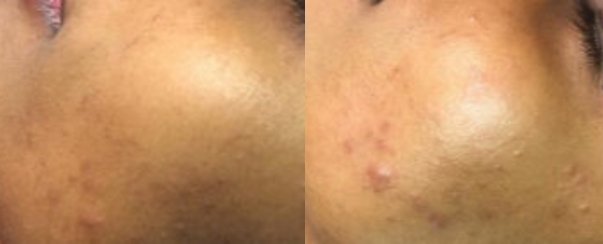 PhotoFacial BA Dallas