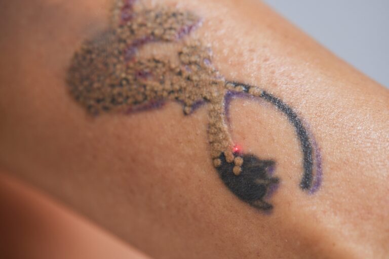 Laser Tattoo Removal Dallas & Plano