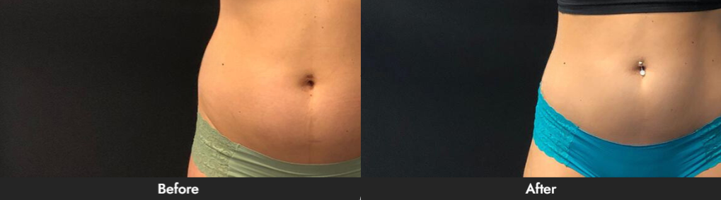 CoolSculpting® vs Laser Lipo Dallas & Plano