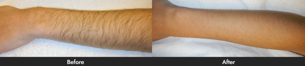 Laser Hair Removal Dallas & Plano