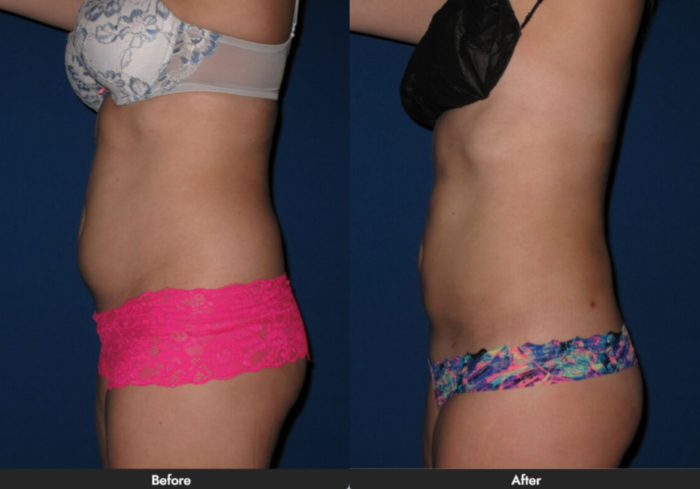 Laser Lipo Laser Lipo