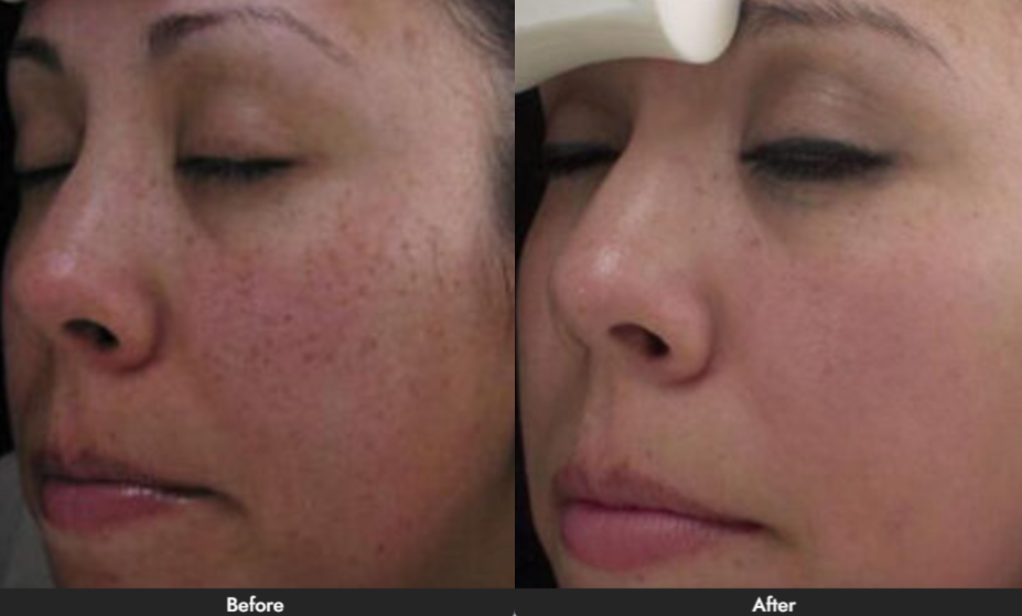 Chemical Peel Dallas & Plano